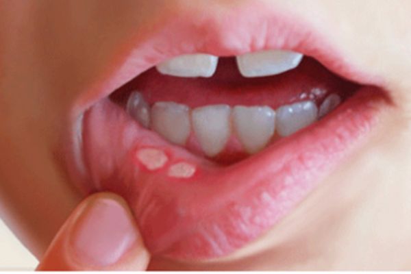 Cách chữa nhiệt miệng đơn giản cho trẻ nhỏ?